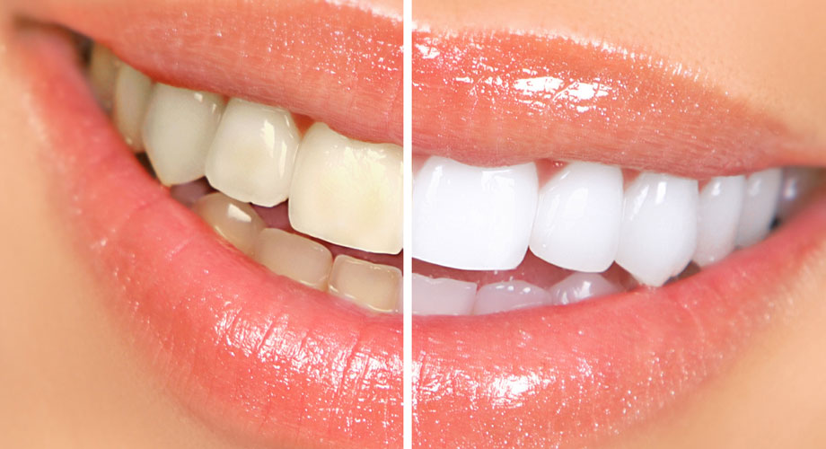 kor whitening system whiter teeth